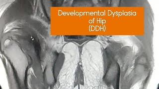 Developmental Dysplasia of Hip DDH mri radiology learning pain ddh [upl. by Alleram]