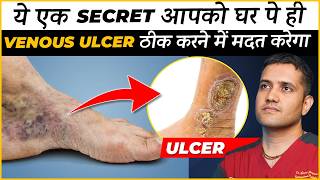 How To Treat Veins Ulcer In Leg At Home  Dr Gaurav Gangwani Interventional Radiologist [upl. by Josepha]