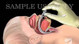 Tracheal Intubation Laryngeal Mask Airway Device [upl. by Llerol]