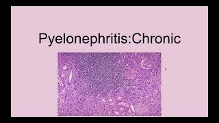 Chronic Pyelonephritis [upl. by Anerat]