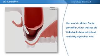 Ablauf der Behandlung  Der Sinuslift [upl. by Wulf]