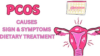 Polycystic Ovary Syndrome  PCOS  Causes  Sign  Symptoms amp Dietary Treatment [upl. by Clarhe]