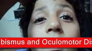 Chronic Progressive External Ophthalmoplegia  شلل عضلات العين [upl. by Einnod]