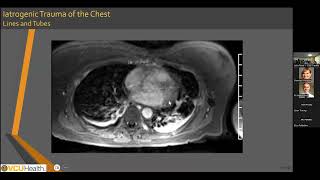 Cardiovascular Magnetic Resonance in Cardiac Iatrogenic Trauma  Leila Rezai Gharai MD [upl. by Otipaga315]