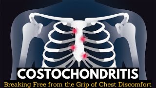 Costochondritis Breaking Free from the Grip of Chest Discomfort [upl. by Eniladam713]