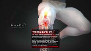 Tendon Ruptures Patellar Tendon and Quadriceps Tendon [upl. by Nadabas68]