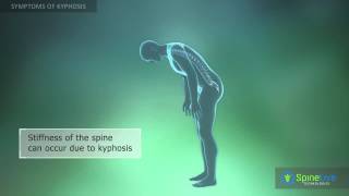 Kyphosis Symptoms [upl. by Theressa980]