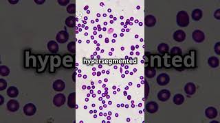 PerniciousAnemia VitaminB12Deficiency Step2Prep MedicalEducation medicalstudent DiagnosticLens [upl. by Erlene]