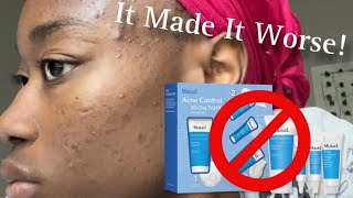 30Day Results My Face Got Worse Using The Murad Acne Kit [upl. by Charline]