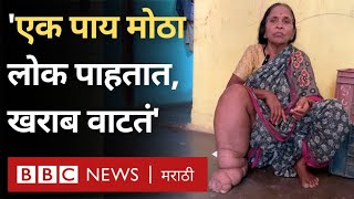 Chandrapur Filariasis  चंद्रपूर जिल्ह्यात हत्तीपाय रोगाचे रुग्ण इतके का वाढले BBC News Marathi [upl. by Eniamrahc]