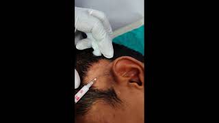 alopecia areata patchy hair loss इन्द्रलुप्त [upl. by Caton]