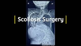 Scoliosis Surgery for Congenital Kyphoscoliosis [upl. by Eagle]