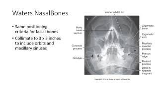 Radiographic Positioning of the Nasal Bones [upl. by Hahsia]