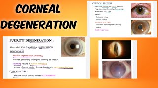 corneal degeneration classification  symptoms  treatment  ophthalmology  English [upl. by Cressler]