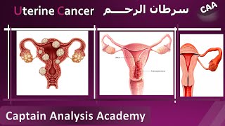 E4 Understanding Endometrial Cancer Uterine cancer سرطان الرحم اسبابة وطرق تشخيصة و علاجه [upl. by Dave905]