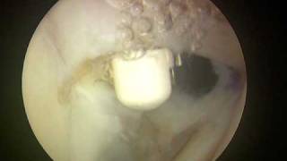 Shoulder Arthroscopy Dr Cascio Biceps tenodesis 2 of 2 [upl. by Elizabeth553]