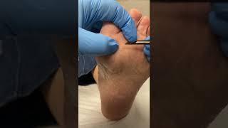 Watch the pros slice through seed corns Your feet will thank you PodiatryMagic CornRemoval [upl. by Tiler125]