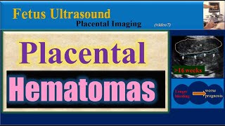 Fetus Ultrasound Placental Hematomas [upl. by Ciredec447]