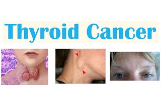 Thyroid Cancer Papillary Follicular Medullary amp Anaplastic  Symptoms Diagnosis Treatment [upl. by Neeli266]