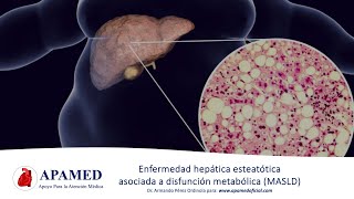 Esteatosis hepática asociada a disfunción metabólica MASLD NAFLD [upl. by Anirehtak]