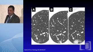 Screen discovered nodules What next [upl. by Mcclish]