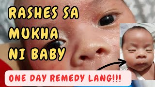 RASHES SA MUKHA ni baby NEONATAL ACNE REMEDY by Dr Pedia Mom [upl. by Oniluap]