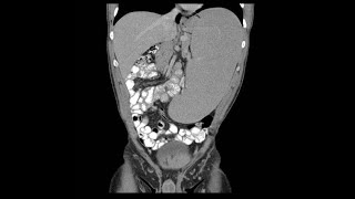 Hepatomegaly amp splenomegaly Hepatosplenomegaly by profMarwa AlEmam [upl. by Atinnod565]