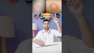 How to Treat and Prevent Ringworm Fast amp Effective Solutions” [upl. by Eimot]