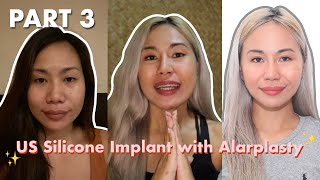 Part 3 Rhinoplasty Journey  KOSMED Clinic US Silicon with Alarplasty [upl. by Elazaro]