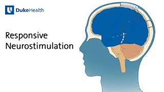 Responsive Neurostimulation RNS for Epilepsy  Duke Health [upl. by Ames]