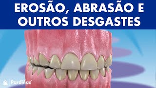 Erosão dentária abrasão abfração reabsorção radicular e outros problemas de desgaste © [upl. by Mountford]