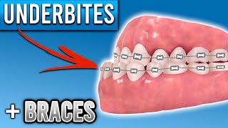 How Do Braces Fix Underbites  Premier Orthodontics [upl. by Epul]