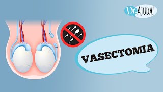 VASECTOMIA O QUE É QUEM PODE FAZER COMO É A CIRURGIA QUAIS OS CUIDADOS [upl. by Latoniah738]