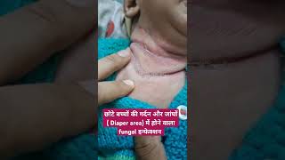 छोटे बच्चों की गर्दन diaper area में होने वाले rashes का कारण और इलाज Cutaneous candidiasis part 1 [upl. by Kcirdorb]