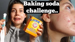 ACNE IS CAUSED BY LOW STOMACH ACID  BAKING SODA CHALLENGE TEST FOR MY STOMACH ACIDS [upl. by Ravel108]