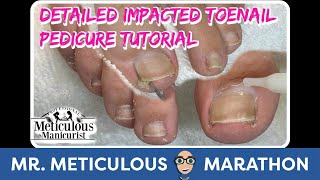 Satisfying Impacted Toenail Cleaning Pedicure Tutorial Detailed Instruction MrMeticulousMarathon [upl. by Peednas]