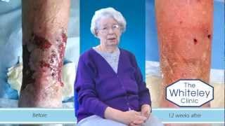 Leg ulcer healed at The Whiteley Clinic [upl. by Ahsitel]