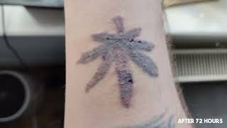 10 Week healing process after 1st Laser Tattoo Removal session [upl. by Emili74]