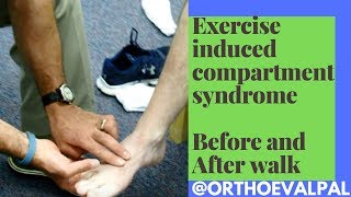 Exercise Induced Compartment Syndrome Signs and Symptoms [upl. by Hum]