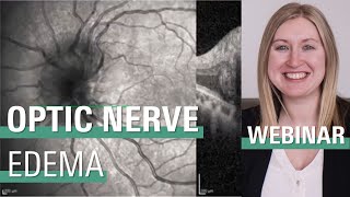 Optimizing OCT for Optic Nerve Edema in Pediatric and Adult Patients [upl. by Rossen]