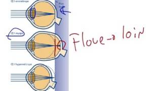 Myopie presbytie et hypermétropie [upl. by Pool]