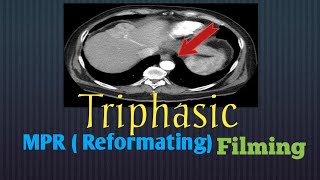 شرح عملReformat لطباعة لفحص المقطعية ثلاثية المراحل علي الكبدMPR for CT triphasic liver for filming [upl. by Bekah]