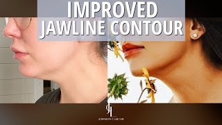 Chin Defining and Contouring with Liposuction Testimonial  Dr Johnson Lee  Beverly Hills [upl. by Reo747]