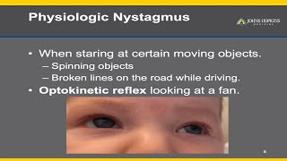 Nystagmus  A Patient Guide [upl. by Coralie]