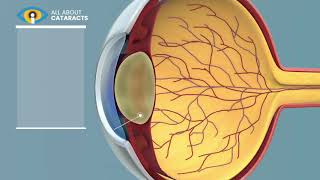 What is a Cataract  Cataract surgery video [upl. by Hoopes]