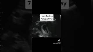 Babys Heart Beating at 7 Weeks 1 Day Pregnant on Ultrasound [upl. by Ellenwahs]