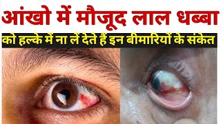 आंख लाल होने का कारण  subconjunctival hemorrhage in hindi  subconjunctival hemorrhage treatment [upl. by Halpern706]