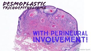 Desmoplastic Trichoepithelioma with perineural involvement [upl. by Arvo]