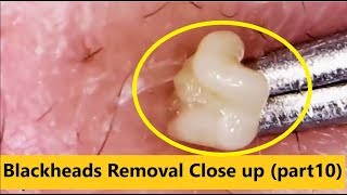 Blackheads Removal Close up part10 [upl. by Rehsu]