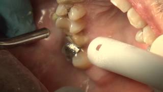 Premier CEREC Prep [upl. by Htrap]